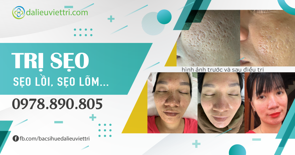 điều trị sẹo lồi, sẹo lõm